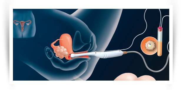 IVF egg retrieval procedure shown with ultrasound guidance and egg collection needle. IVF egg retrieval procedure shown with ultrasound guidance and egg collection needle.